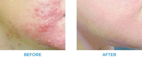 Acne Treatments in Dewsbury