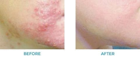 Acne Treatments in Rotherham